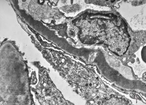 M,29y. | type II membranoproliferative glomerulonephritis (dense deposit disease) M,29y. | type II membranoproliferative glomerulonephritis (dense deposit disease)